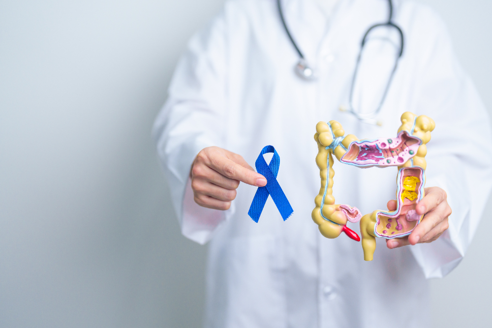 Colon Cancer