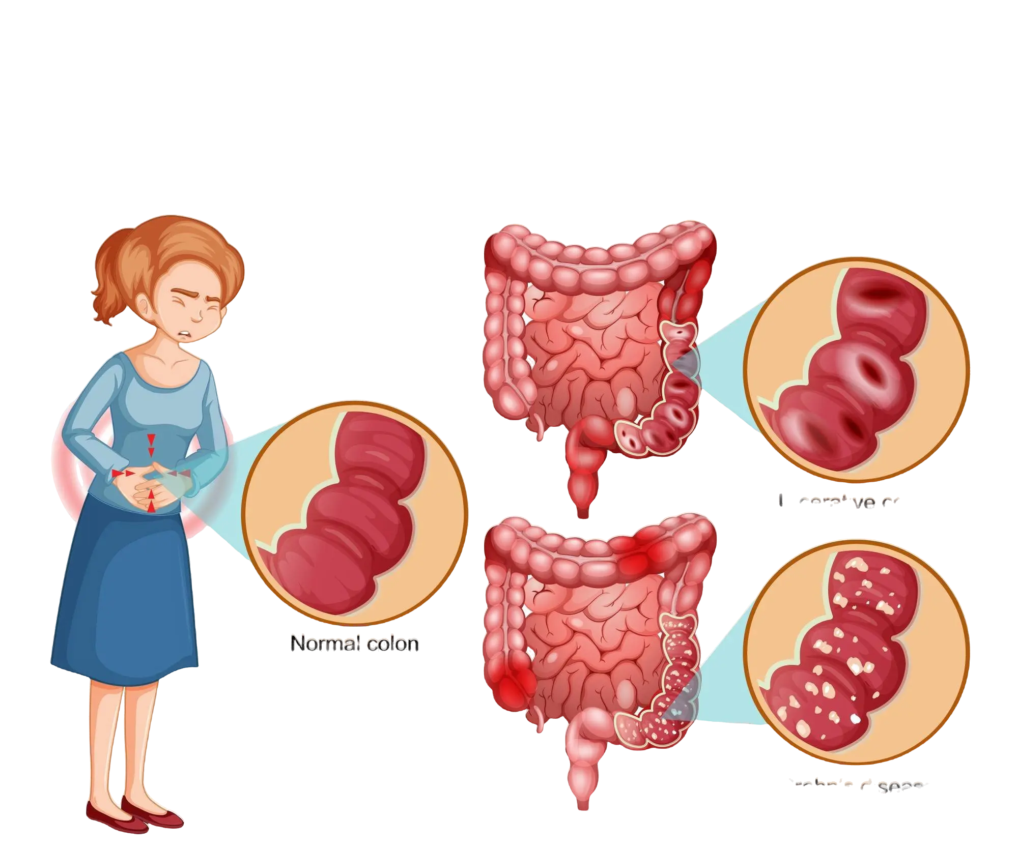 IBD 