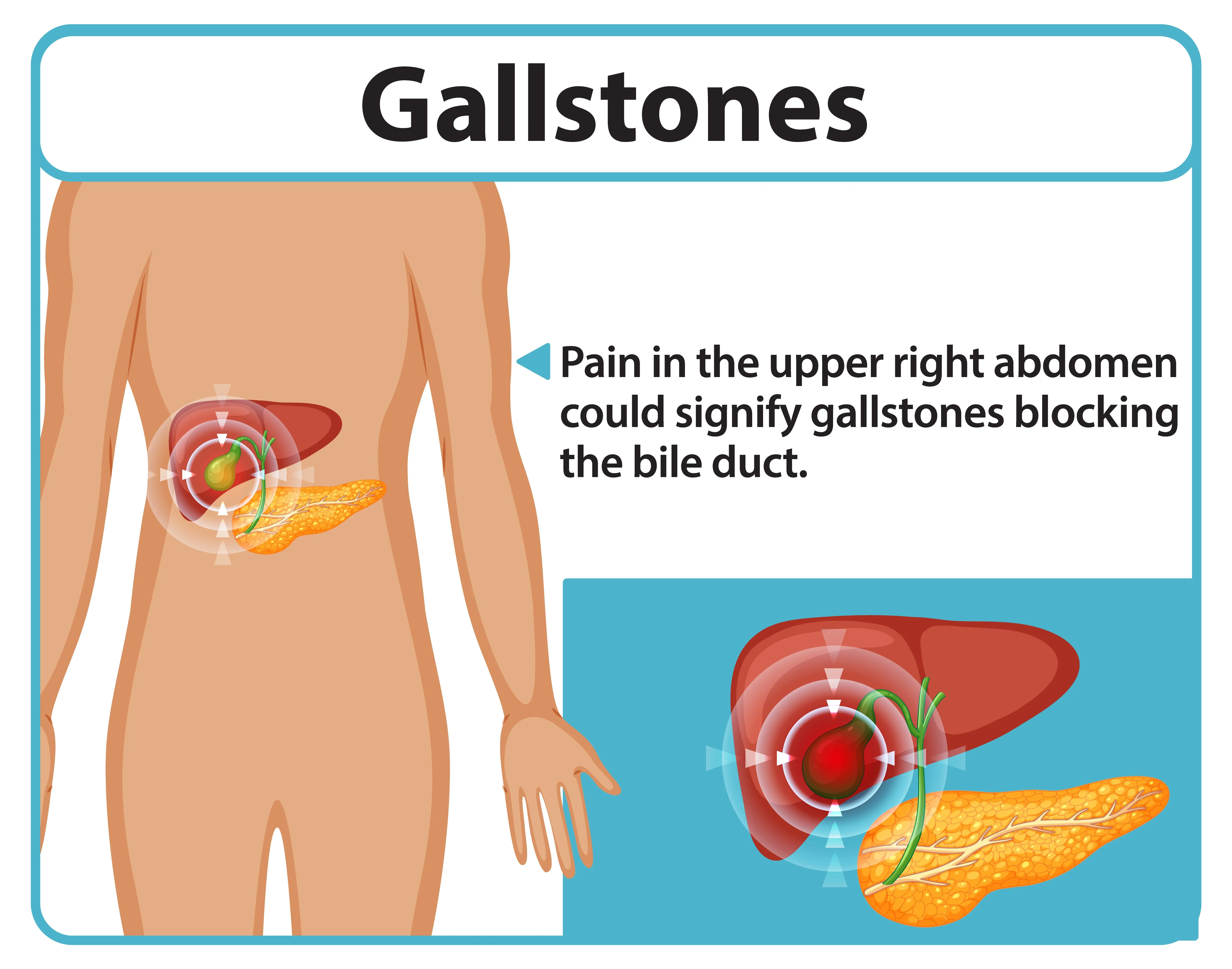 What causes gallstones? | Bangalore Gastro Centre, image size:5315x4181