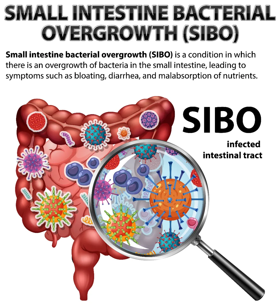 SIBO Symptoms: Recognising Small Intestinal Bacterial Overgrowth